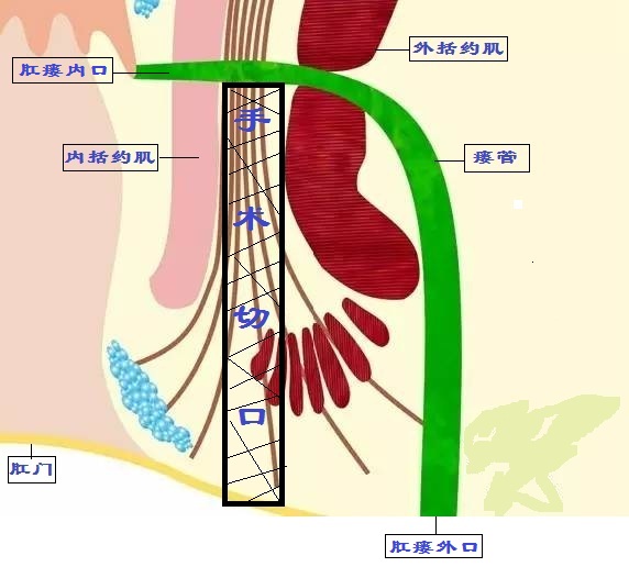 用注射器经外口注入双氧水,从肛门内观察由哪里流出,以此来辨别内口.