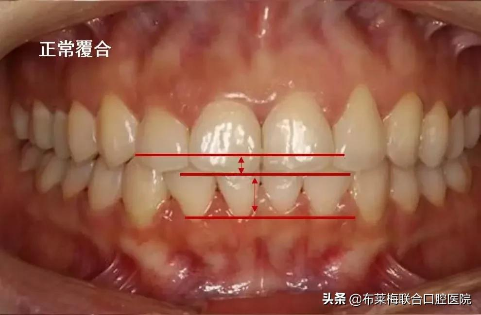 牙齿矫正,你所关心的那些问题