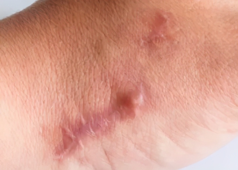 凹陷和凸起，疤痕为什么会产生不同？