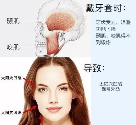 正畸日记 | 我花了3万块钱戴了牙套，现在后悔了