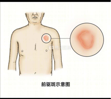 上覆糠秕样鳞屑的玫瑰色的斑丘疹，先有母斑，可能是玫瑰糠疹