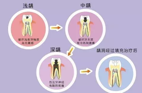 补牙价格差异如此巨大,你不知道的补牙“秘密”全都在这里!