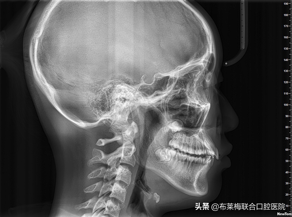 自己网购DIY牙套做矫正可以吗？牙医：我想静静