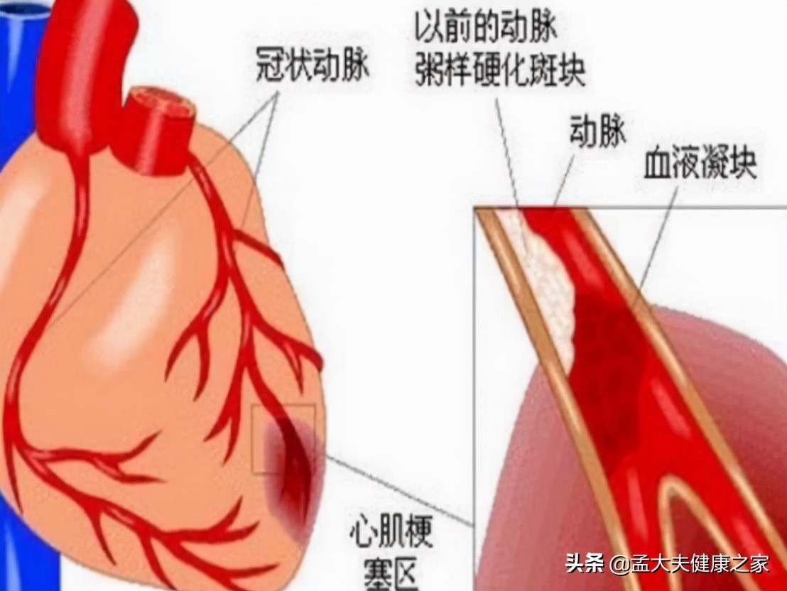 心梗急救，用丹参滴丸能起作用吗？2种药物才是心梗适用药