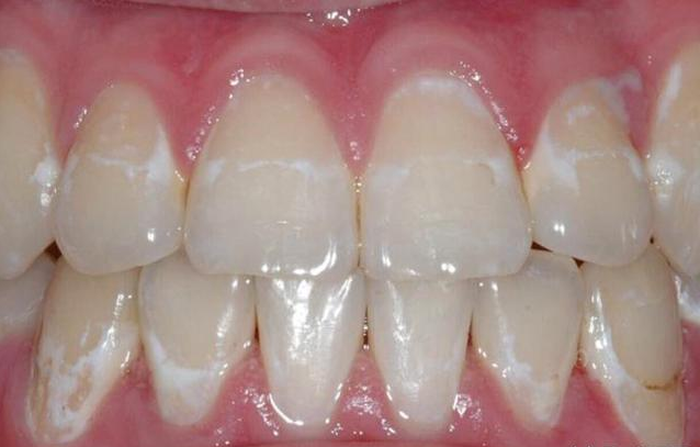 牙龈白斑初期症状图片(牙齿出现白斑要警惕了) - 赤虎壹号