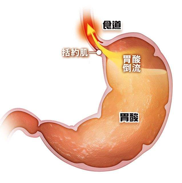饭后“烧心”折磨人，到底是哪个器官生病了？这些办法能缓解