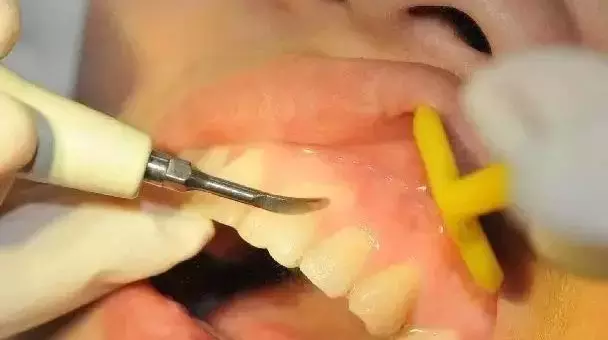 洗牙普通200,深度3000,深度洗牙是忽悠还是真的?
