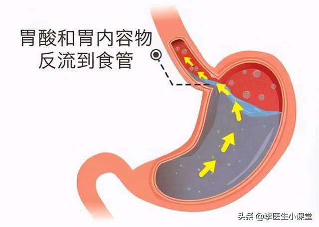 烧心反酸，反流性食管炎该怎么办？医生：这三类药物，效果极佳