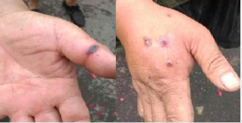 北京发现1例、山西发生皮肤炭疽疫情，炭疽可怕吗？会人传人吗？