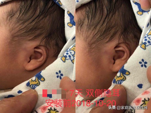专家呼吁：新生儿耳廓畸形矫正不能等，抓着这个黄金治疗期