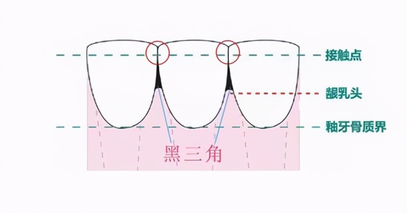 牙齿出现黑三角怎么办？真的是不可逆的吗？