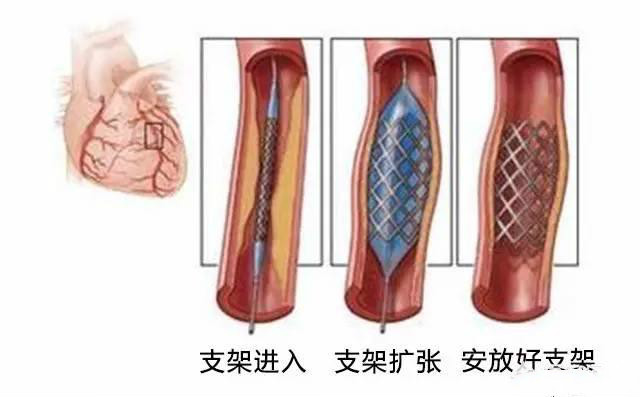 辟谣！进口支架是不是比国产支架更好？专家揭露：从4方面来比较