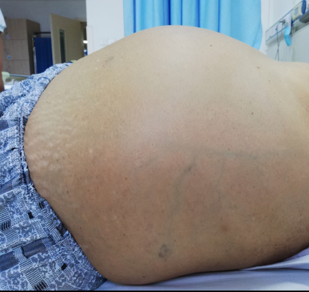 一旦皮肤上出现这种红痣,十有八九是肝硬化,最好检查一下