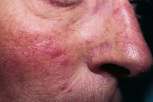 被确诊玫瑰痤疮?那这几件事一定要了解