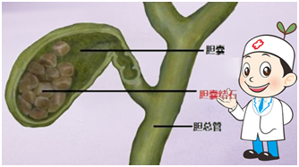 胆囊切除后对身体会有哪些影响？还能吃鸡蛋吗？