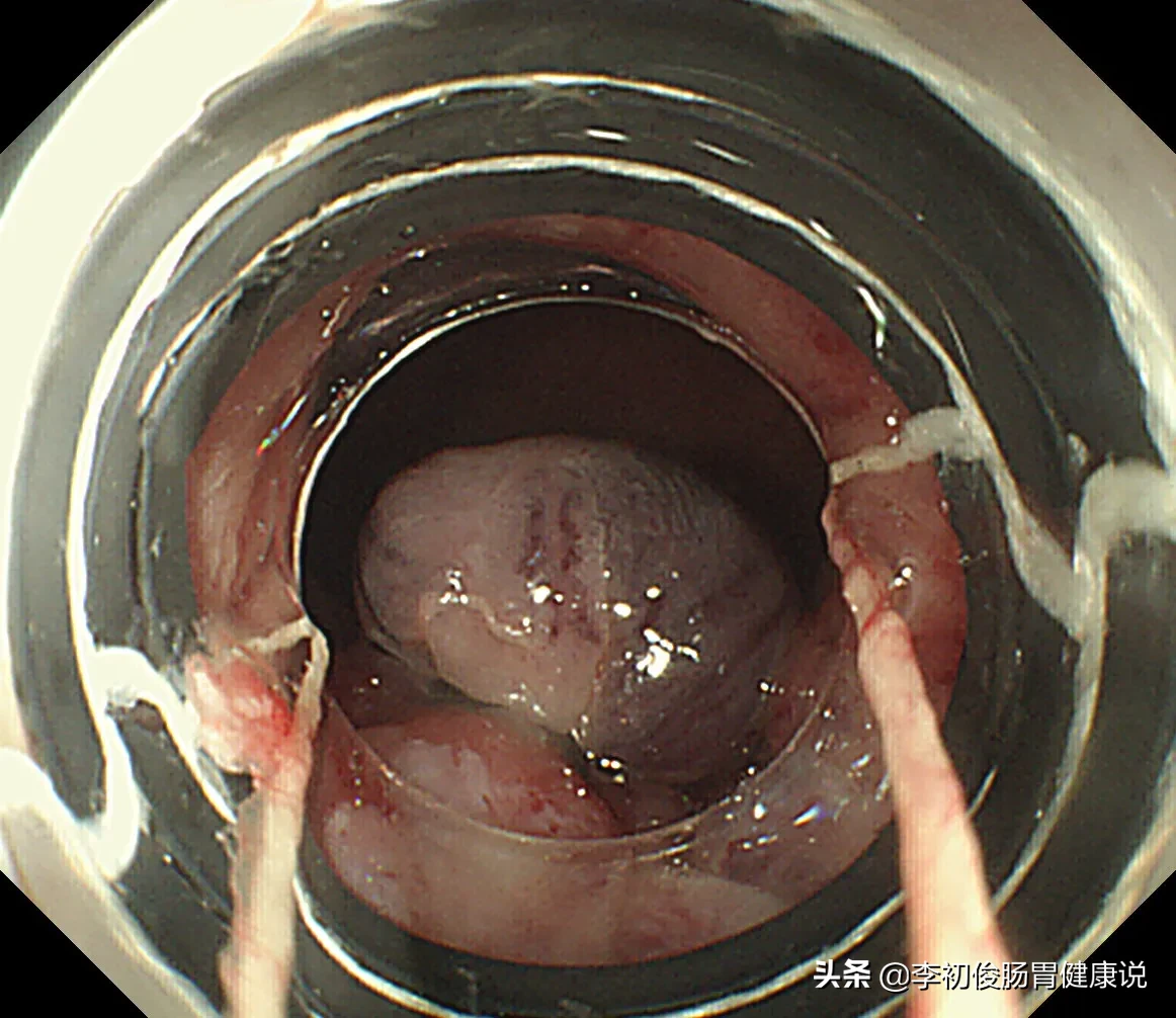 一次肠镜操作，一举三得同时完成肠道检查、套扎止血、消除内痔！