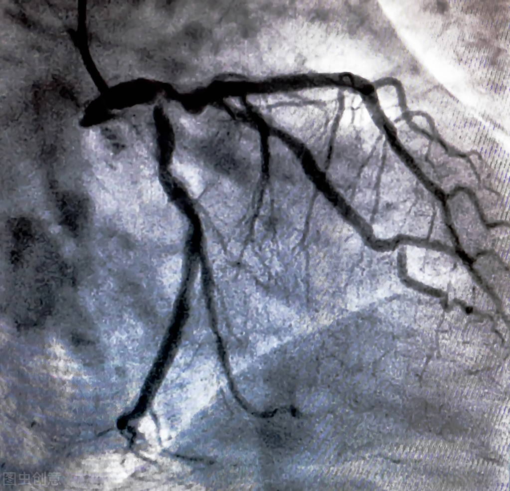 冠脉造影是诊断冠心病的金标准，但绝不能随便检查，医生揭秘