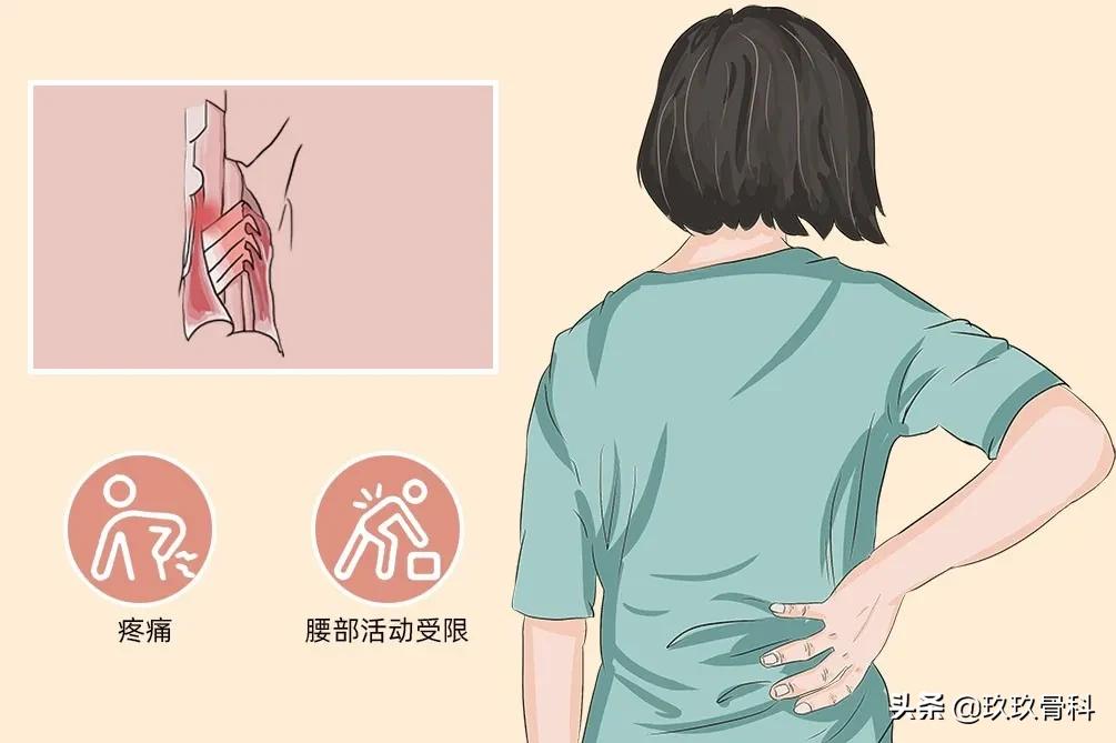 腰肌劳损有哪些症状(女性腰肌劳损一般在哪个部位) 