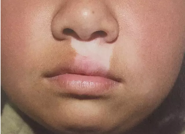 如何区分白色糠疹和白癜风?