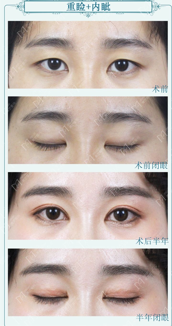 使用双眼皮贴可以贴出来双眼皮是真的吗？