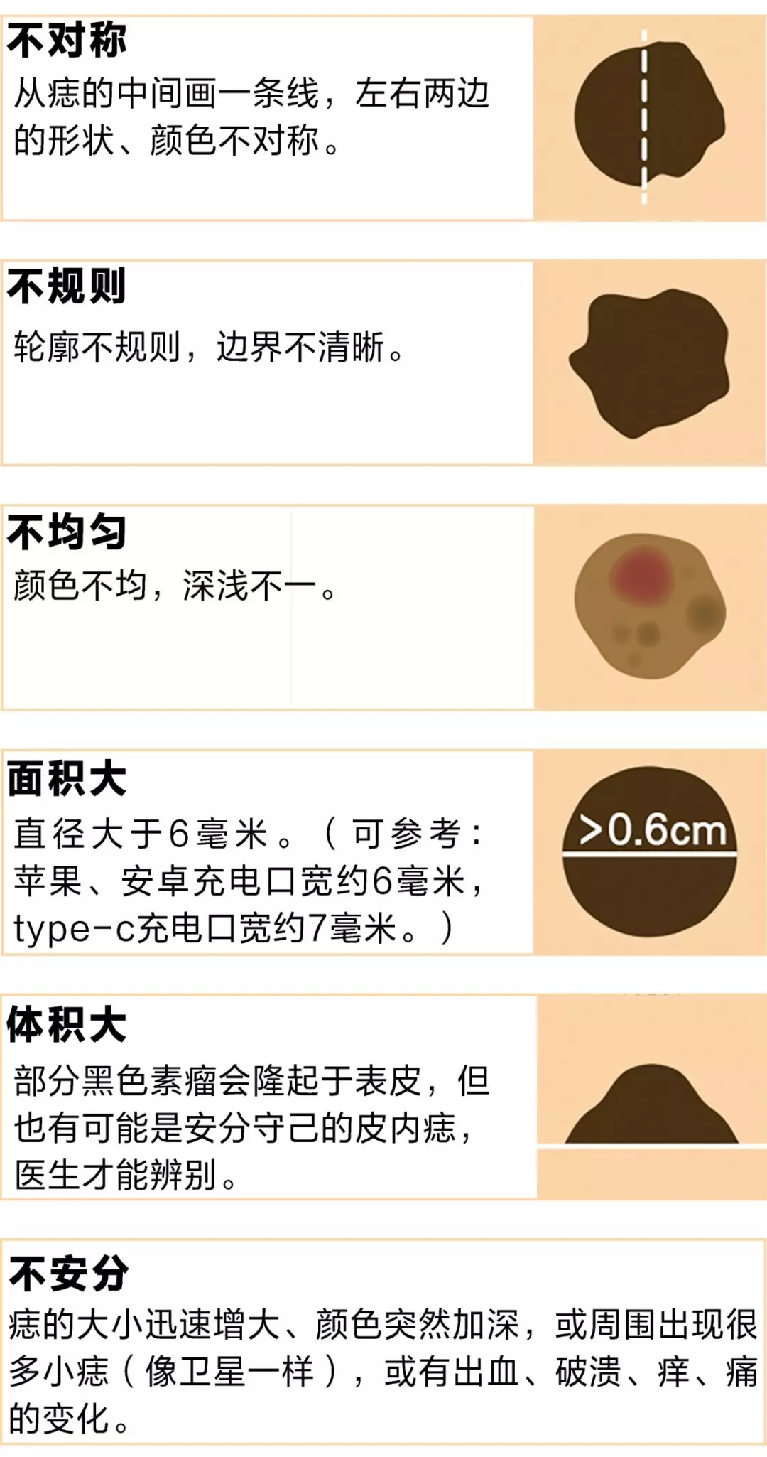 身上有这几种痣最好去点掉，尤其是长在隐秘部位的