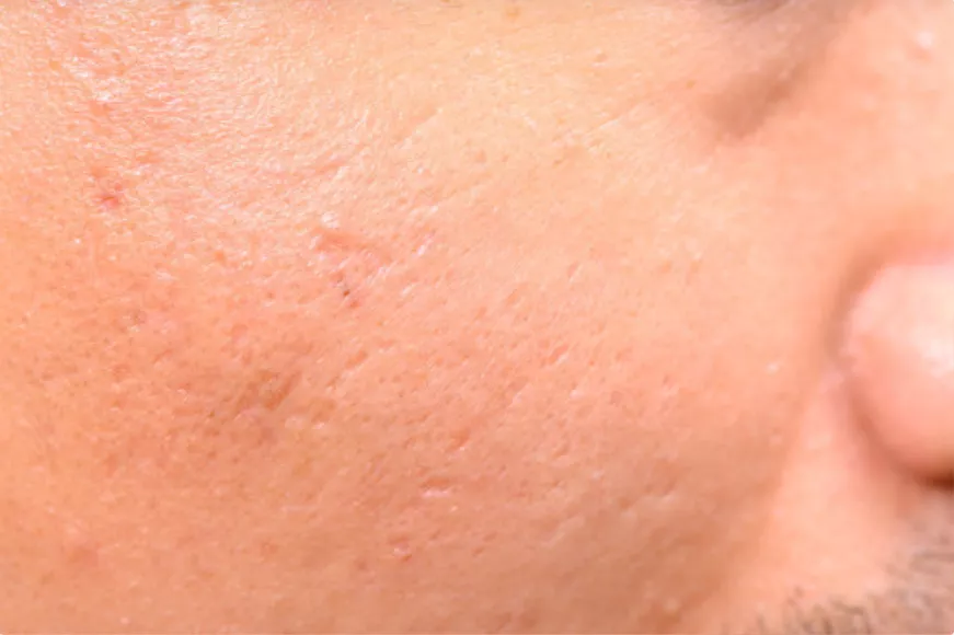 凹陷和凸起，疤痕为什么会产生不同？