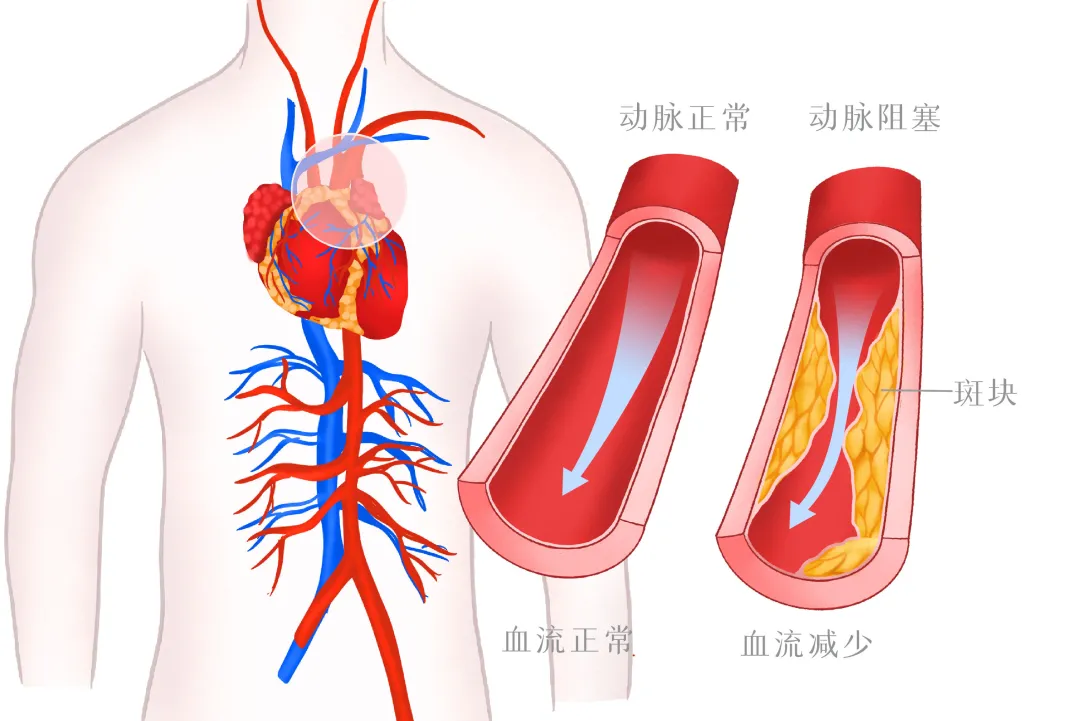 血管“堵”了,心梗、脑中风、猝死来敲门?5招拯救血管