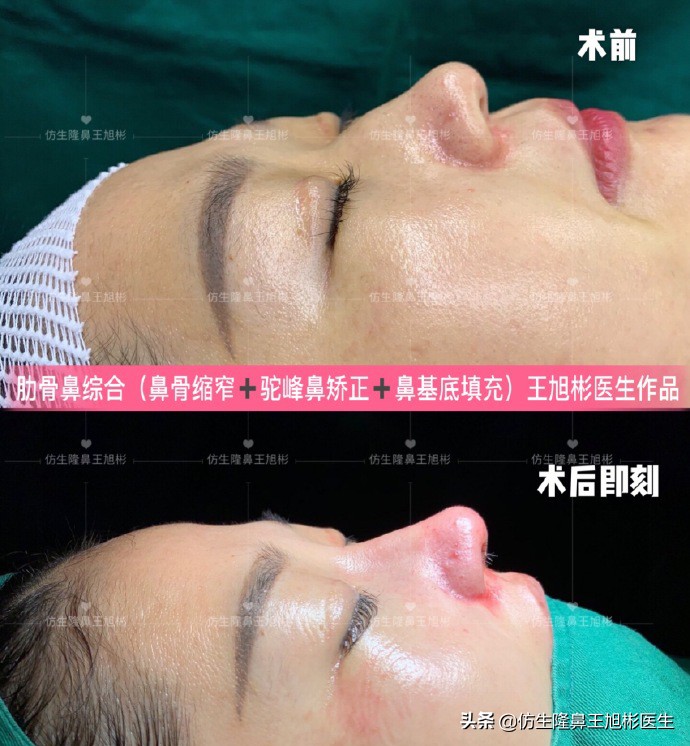 单纯隆鼻是什么，和综合隆鼻有什么区别？
