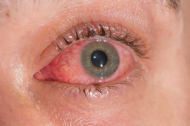 川崎病红眼睛图片图片