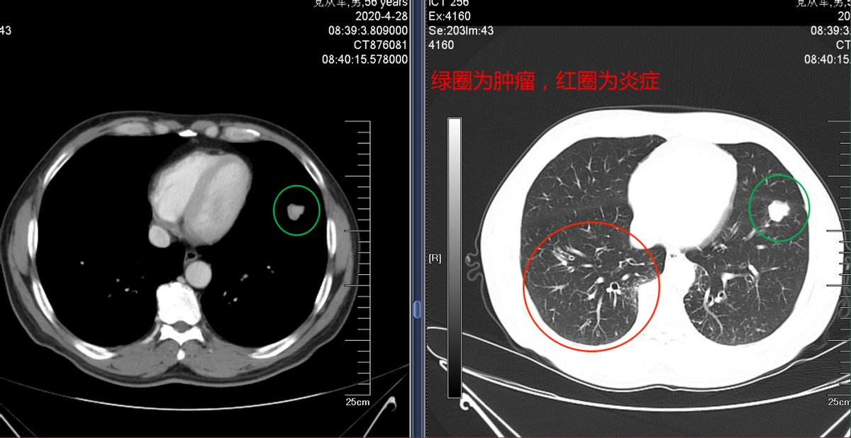 中医药联合化疗治疗肺腺癌取得奇效：肿瘤居然消失了