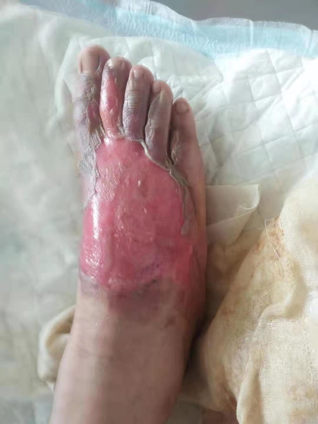 12岁小学生被老师安排搬营养餐烫伤，家长称学校给3000元后不再过问，校方：若索赔过多难承担