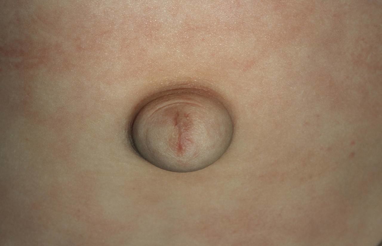 新生儿脐部容易出现的6个异常情况