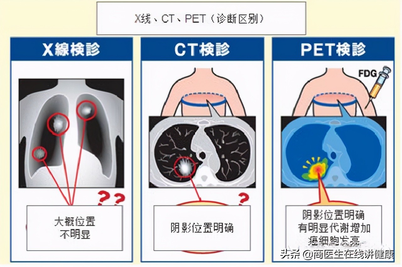 Como funciona o PET/CT? - Spect