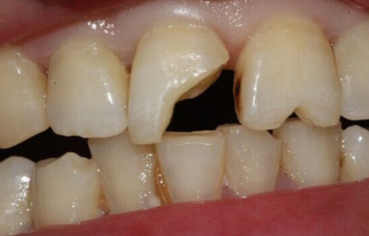 上门牙不小心磕掉一块,露齿影响美观怎么办?口腔医生支一招