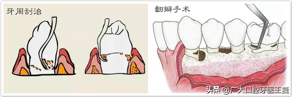 专家提醒：七成牙齿松动不需要拔除！正确做法应该是