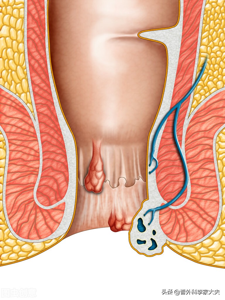 直肠肛门周围疼痛,会是什么病?
