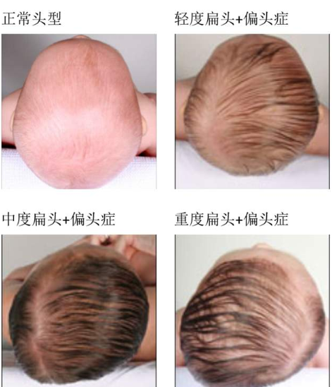 婴儿头顶尖怎么调整(孩子) - 乐宝宝贝