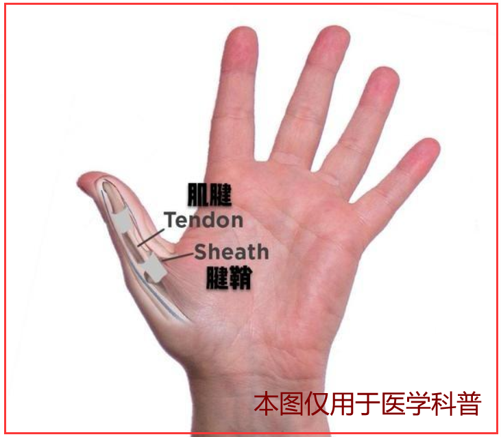 手指有腱鞘炎，怎么治才能好得快？别花冤枉钱了，医生教您5招