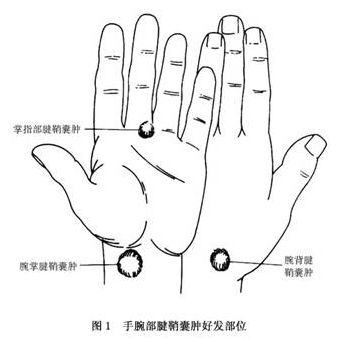 腱鞘囊肿—手部包块最常见疾病！不是一定要手术！如何治疗、预防