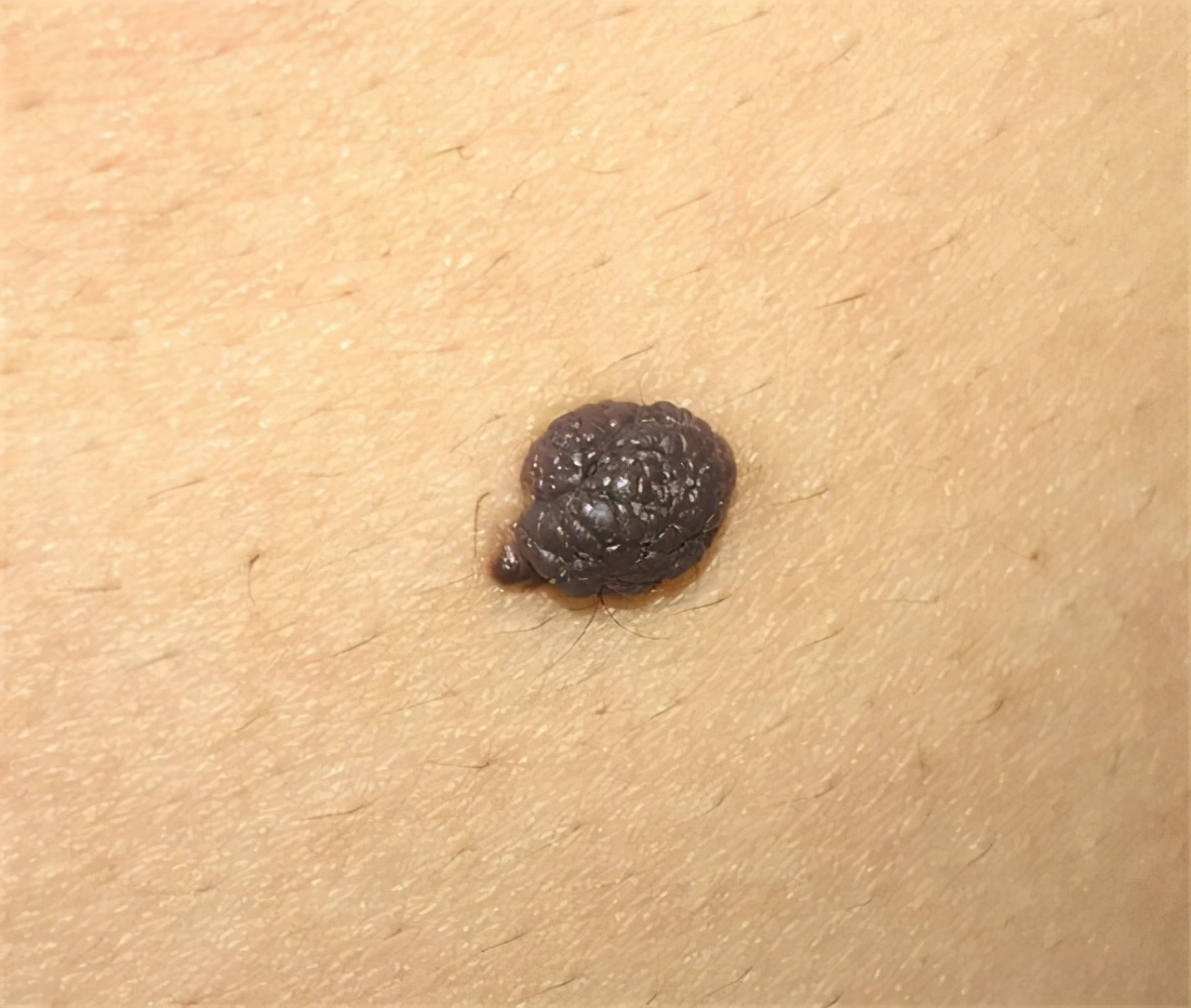 大姨妈黑褐色怎么回事(如何区别黑痣和黑色素瘤)