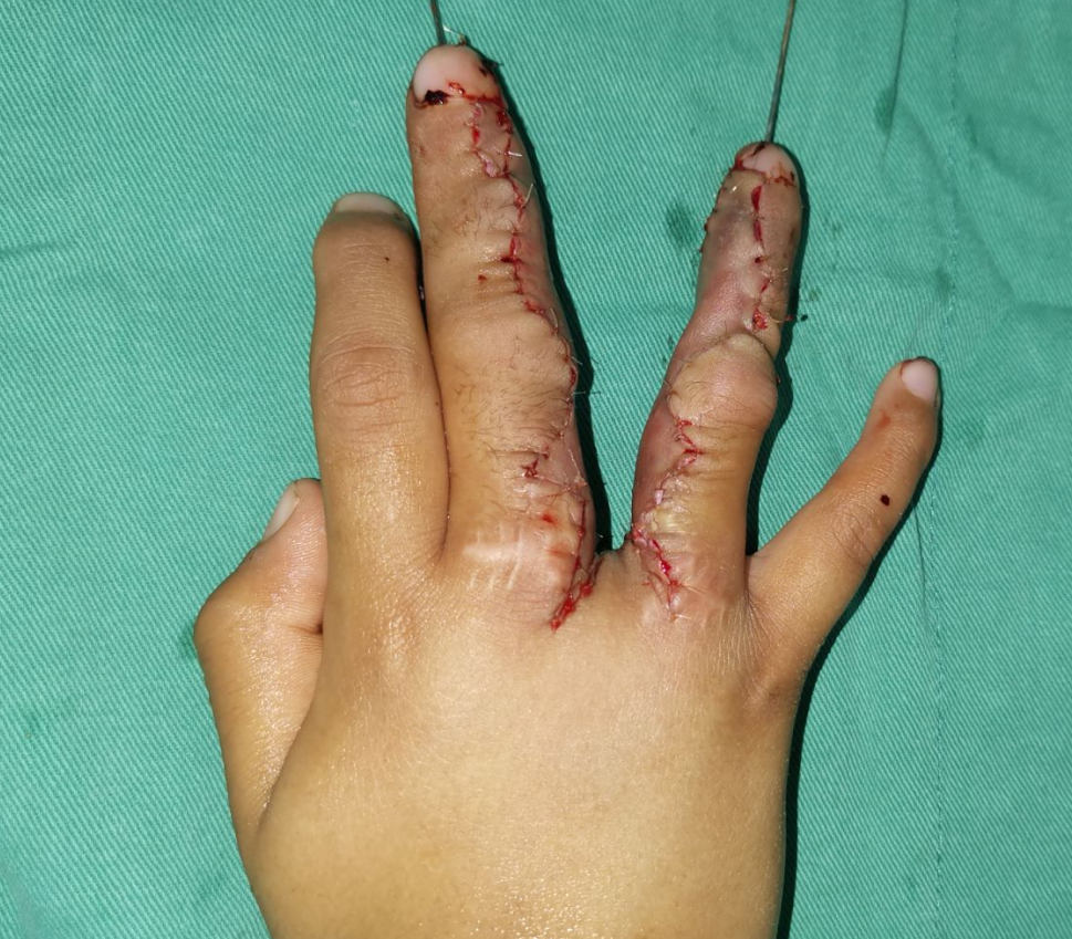 并指畸形常见问题解答及「手术案例合集」