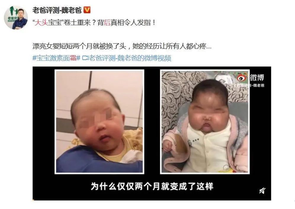 “大头娃娃”再现，婴儿湿疹滥用激素药膏，宝妈们睁大眼睛辨别