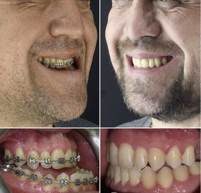 骨性龅牙模型图片