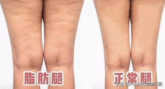 萝卜腿不敢穿小黑裙？最全瘦小腿套餐，一周拯救小腿粗恣意穿