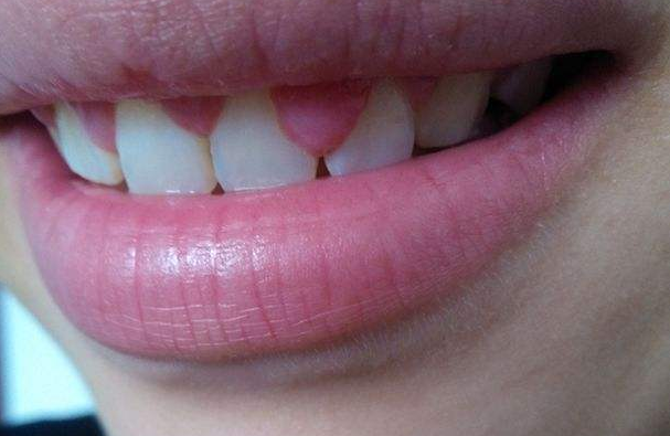 在龈乳头处,接近于牙体的位置,靠近唇颊侧或者是舌侧,没有固定的形状