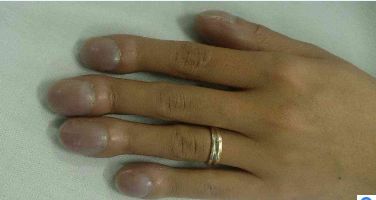 杵状指图片,杵状指图片常见于什么病