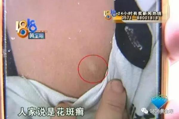 两个白点，“丽都”没确诊，花了近六千！又去三甲医院，只花两百