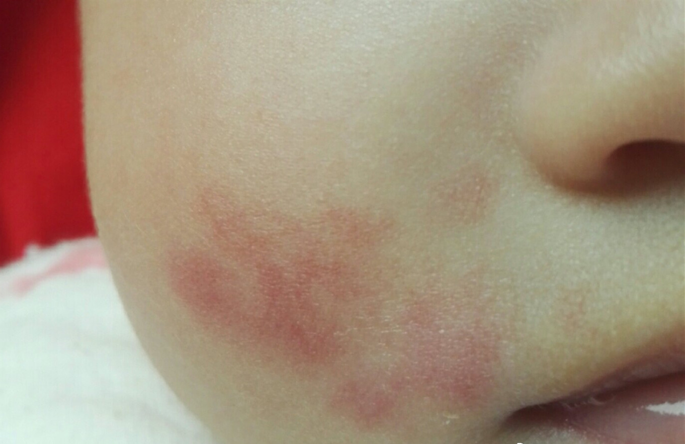 胎记在表皮还是真皮会越长越大吗(胎记种类多样,危害各不相同)