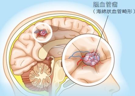 小孩脸上长了“红疙瘩”，到底该不该治疗？