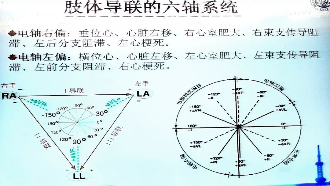 儿童心电图——你真的会读了吗？